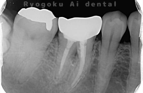 右下６番近心根パーフォーレーションレントゲン