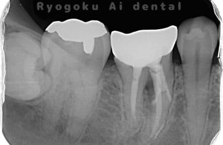 外科的パーフォレーションリカバリー術後レントゲン