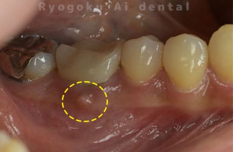 右下６番近心根パーフォーレーション