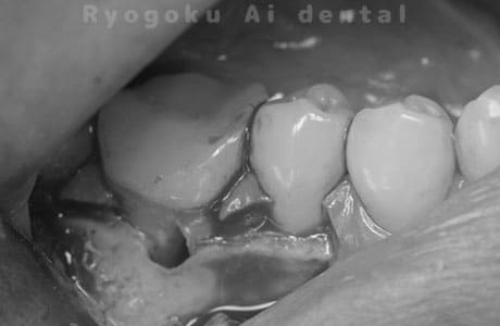 外科的パーフォレーションリカバリー治療術中
