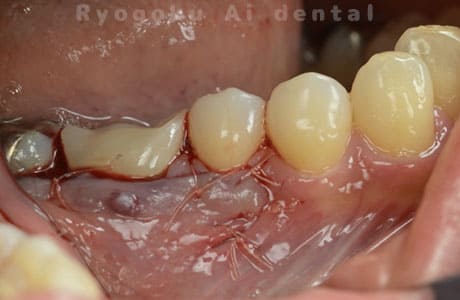 外科的パーフォレーションリカバリー治療術中