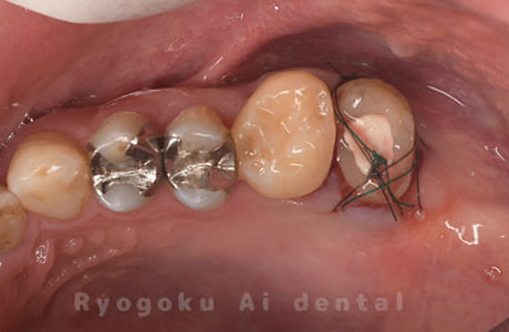 パーフォレーションリペア、再植治療