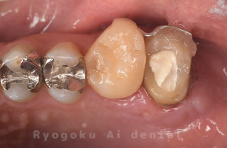 パーフォレーションリペア、再植治療