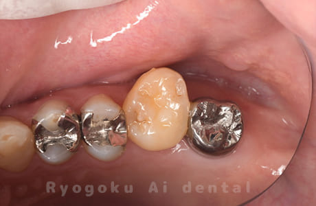 パーフォレーションリペア、再植治療