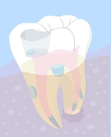 MTAセメントとは<