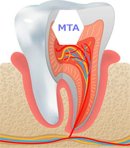 MTAセメントによる神経を残す治療