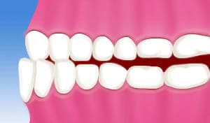 受け口、下顎前突、しゃくれ、反対咬合