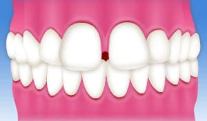 すきっ歯、空隙歯列弓