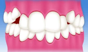 叢生、乱杭歯、八重歯