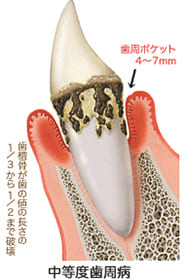 中等度歯周病