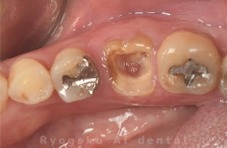 左下６番髄床底部パーフォレーションならびに重度カリエス