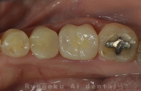左下６番パーフォレーションリペアを伴うマイクロエンド治療、ジルコニアクラウンレー修復