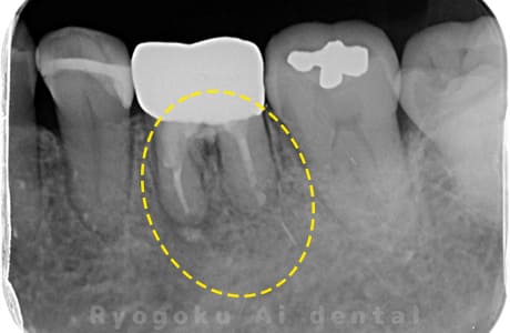 左下６番パーフォレーションリペアを伴うマイクロエンド治療、ジルコニアクラウンレー修復レントゲン写真術後