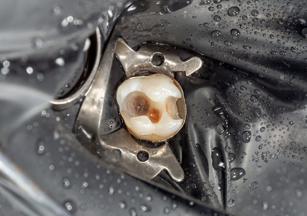 歯を守るための最後の砦としての根管治療