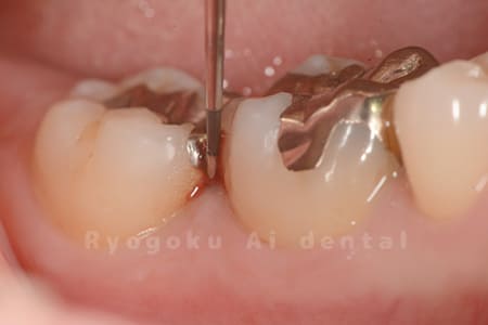 中等度慢性歯周病