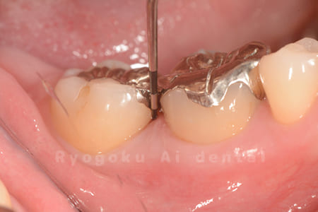 中等度慢性歯周病の再生療法