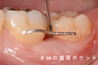 歯周ポケットの確認
