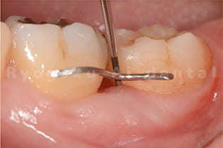 再度プローブにて歯周ポケットの状態を確認