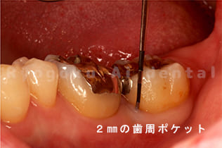 半年後に再度歯周ポケットの状態を確認