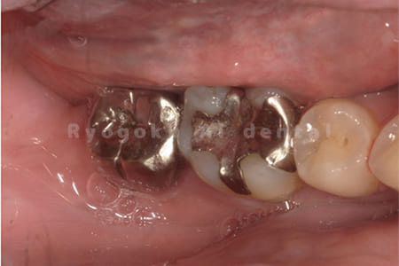 慢性根尖性歯周炎