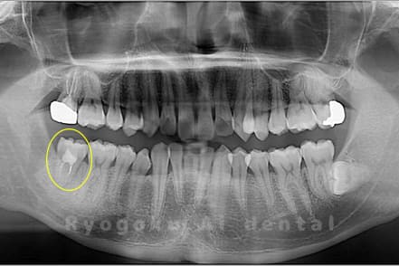 自家歯牙移植術後レントゲン