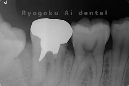 自家歯牙移植術前レントゲン