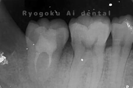 自家歯牙移植術後レントゲン