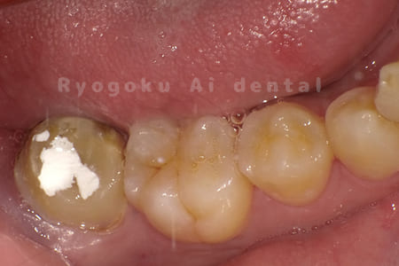 自家歯牙移植術前