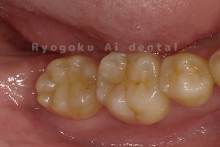 自家歯牙移植術後