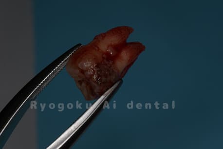 自家歯牙移植の親知らず