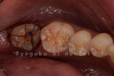 自家歯牙移植術中