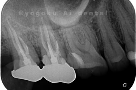 重度カリエス（C4）のレントゲン