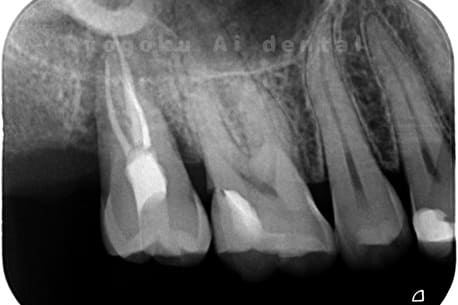 自家歯牙移植後のレントゲン