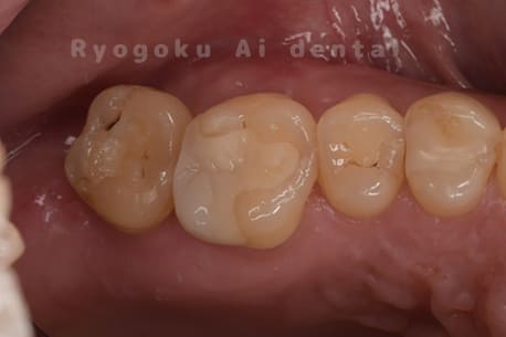 自家歯牙移植術後