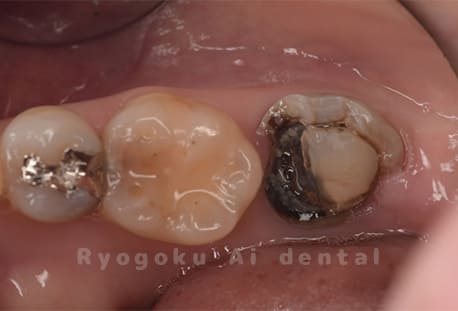 慢性根尖性歯周炎