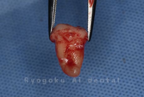 自家歯牙移植の親知らず