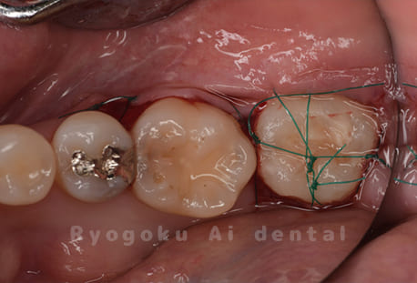 自家歯牙移植術中