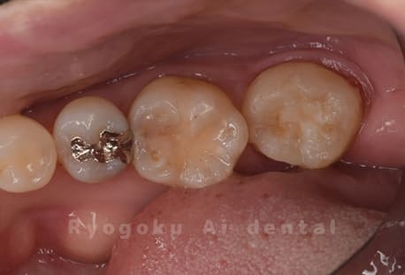 自家歯牙移植術後