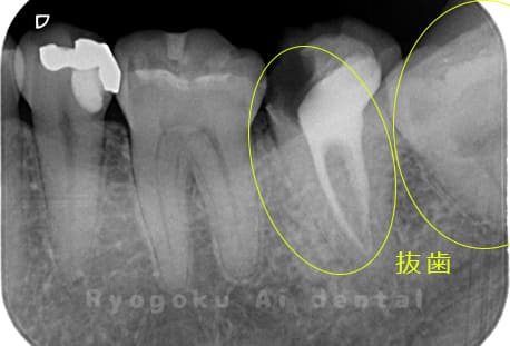 重度カリエス（C4）のレントゲン