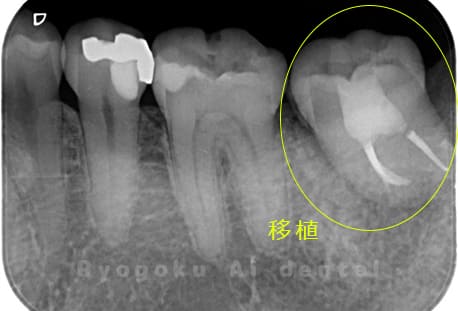 自家歯牙移植後のレントゲン