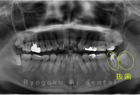 重度カリエス（C4）のレントゲン