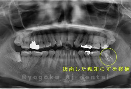 自家歯牙移植後のレントゲン