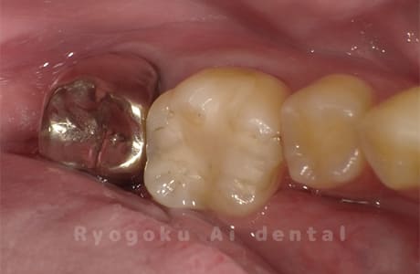 慢性根尖性歯周炎