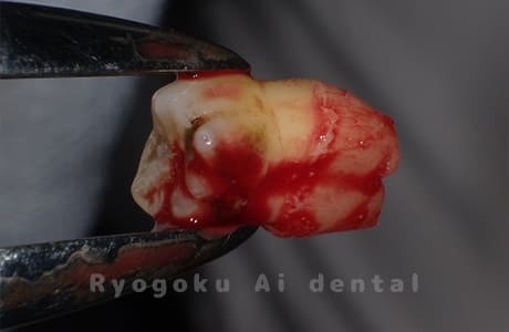 自家歯牙移植の親知らず
