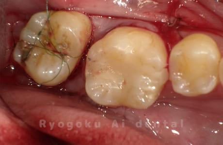 自家歯牙移植術中