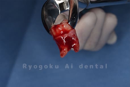 自家歯牙移植の親知らず