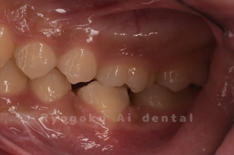 自家歯牙移植術後