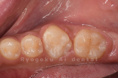 自家歯牙移植術後