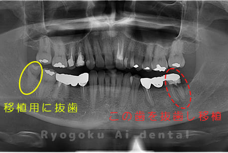 左下7重度カリエスレントゲン