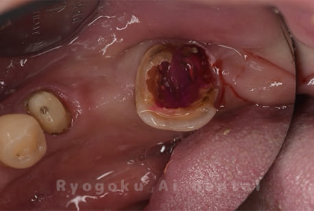 左下7番、重度カリエス